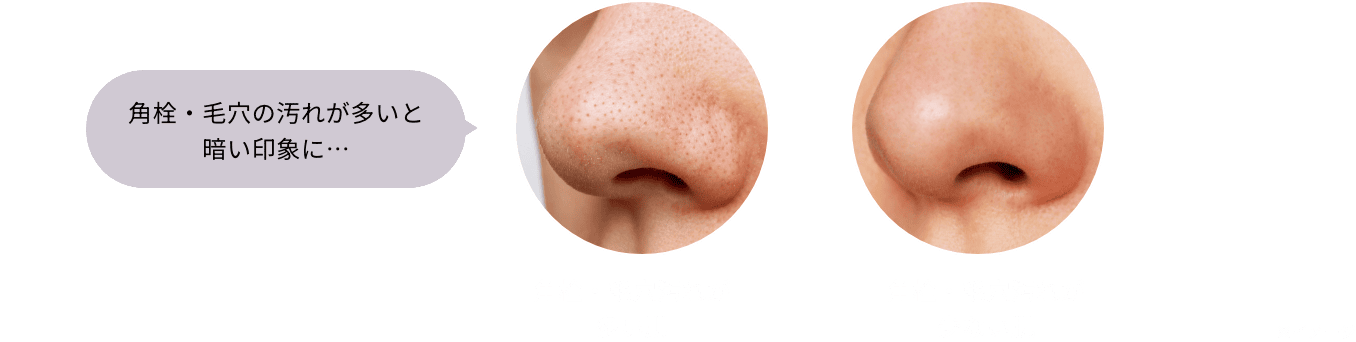 鼻の角栓・毛穴の汚れによる印象の変化を示す比較図。左側に『角栓・毛穴の汚れが多いと暗い印象に…』というテキストと汚れが目立つ鼻の画像、右側に汚れのない滑らかな鼻の画像を並べています。